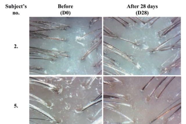 탈모 관리의 새로운 변수, 블랙커민씨오일의 가능성